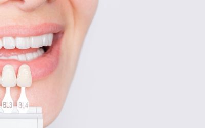 Are Dental Veneers Worth It?